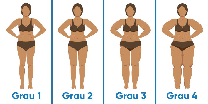 Lipedema e grau Lipedema e grau